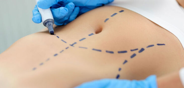 The Future of Body Contouring: Innovations in Tummy Tucks