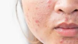 How to Make Pimples Less Red: Fast and Effective Remedies