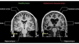 Is A Brain Scan The New Gold Standard For Alzheimer’s Screening?