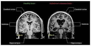 Is A Brain Scan The New Gold Standard For Alzheimer’s Screening?