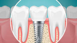 Why Cosmetic Dentists Focus On Smooth Transitions Between Teeth And Implants