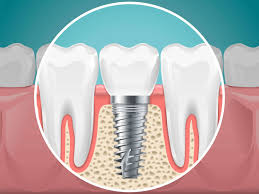Why Cosmetic Dentists Focus On Smooth Transitions Between Teeth And Implants