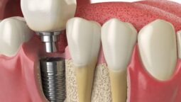 Why Implant Supported Restorations Outperform Traditional Options