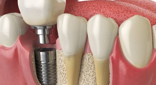 Why Implant Supported Restorations Outperform Traditional Options