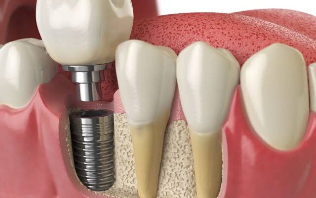 Why Implant Supported Restorations Outperform Traditional Options
